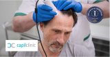 Capilclinic, l’une des meilleures cliniques de greffe de cheveux en Turquie