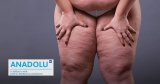 Lipœdème : ne confondez pas ce trouble avec la cellulite ou l’obésité